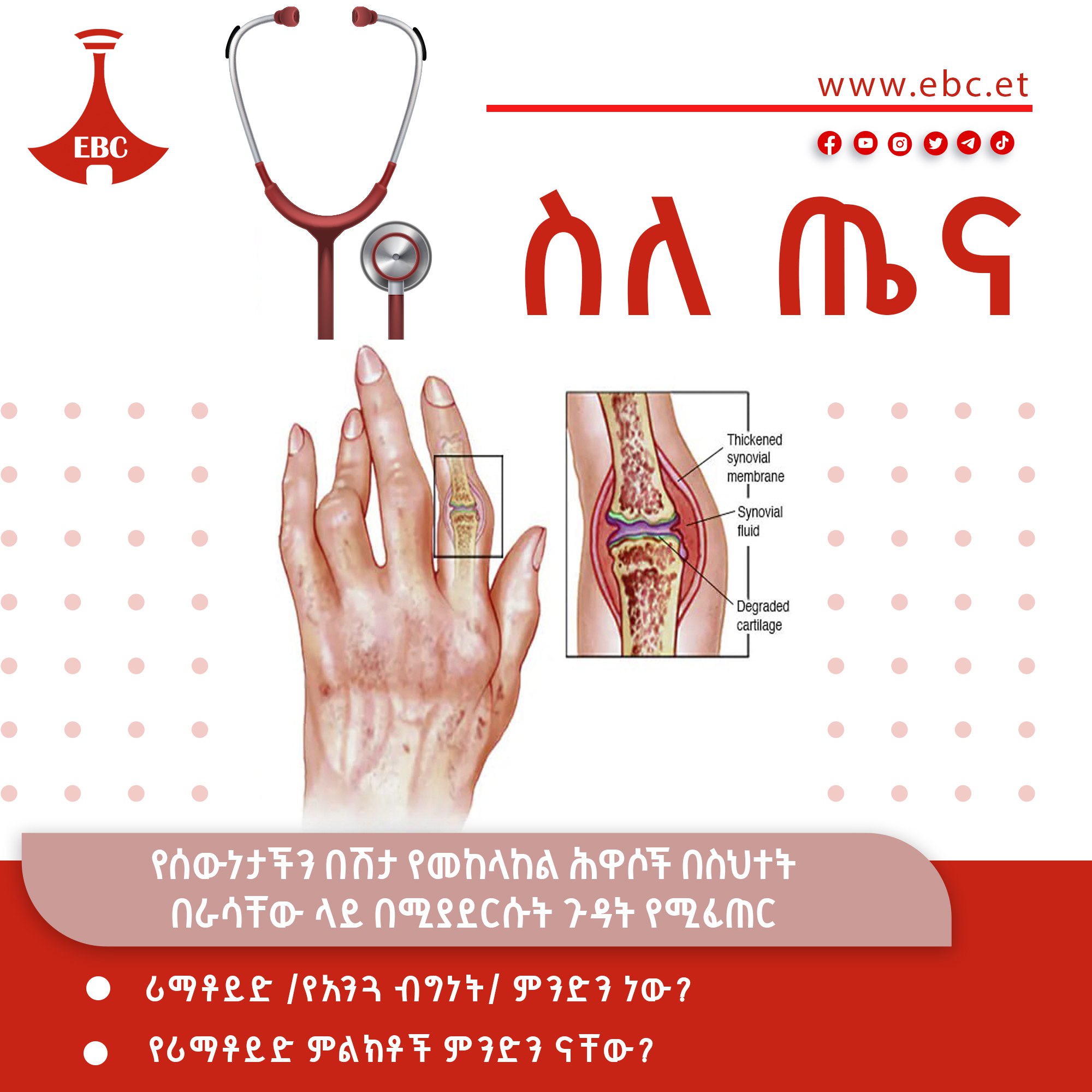 ሪማቶይድ /የአንጓ ብግነት/ ምንድን ነው?